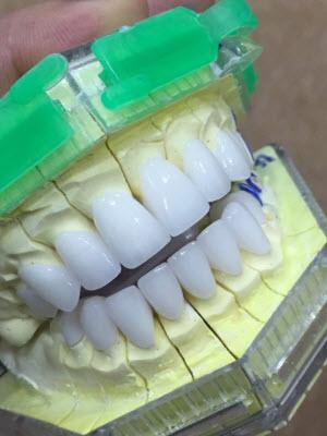 NHỮNG ƯU ĐIỂM CỦA RĂNG ZIRCONIA LÀ GÌ ?